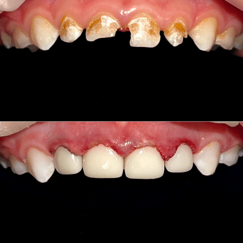 Лікування 12 зубів у медикаментозному сні Кирил 2 роки 
