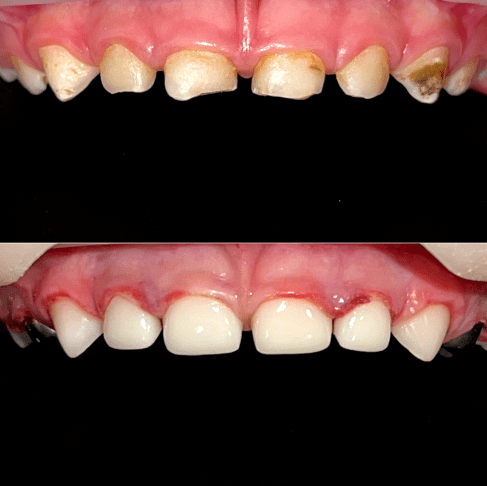 Лікування 13 зубів у медикаментозному сні Дана 3 роки 
