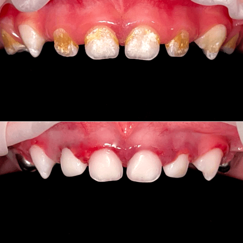 Лечение 9 зубов в медикаментозном сне Кира 2 года