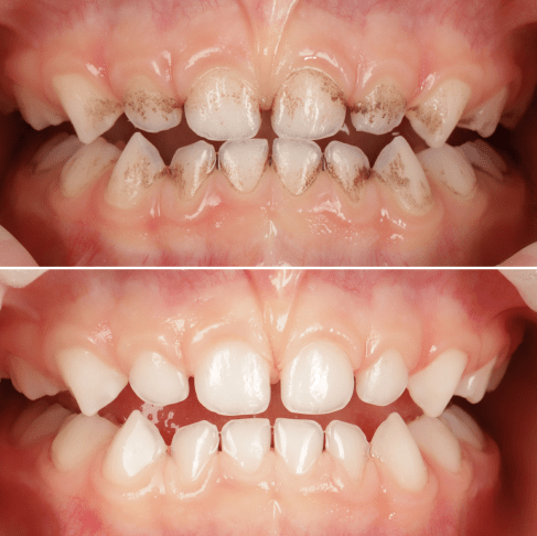 Мирослава, 4 года Профессиональная чистка зубов