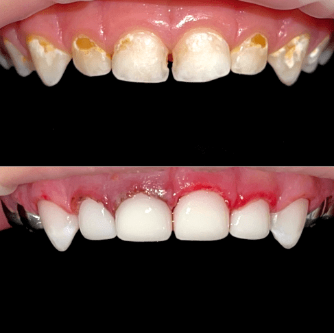 Лікування 16 зубів у медикаментозному сні Павло 3 роки