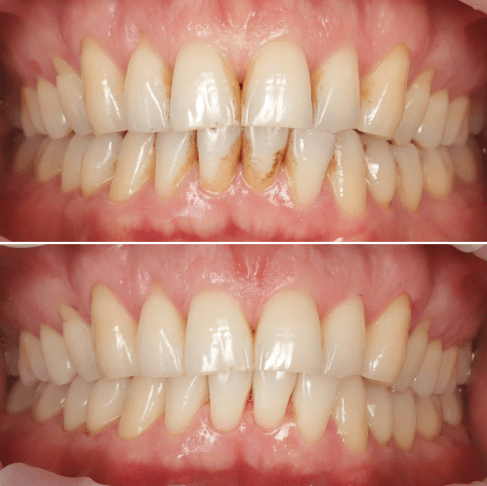 Євген Професійна комплексна чистка зубів